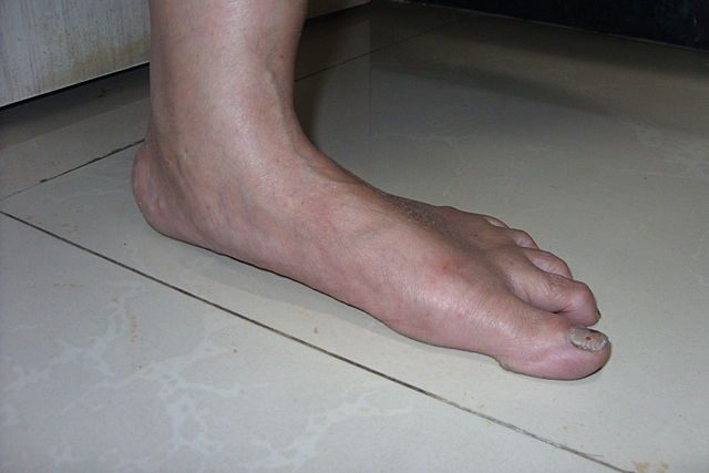 640px-adult_flatfoot-7267881