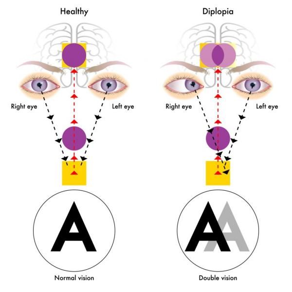 illustration-depicting-diplopia-or-double-vision-and-healthy-eye-vision-comparison-1024x1024-9751441