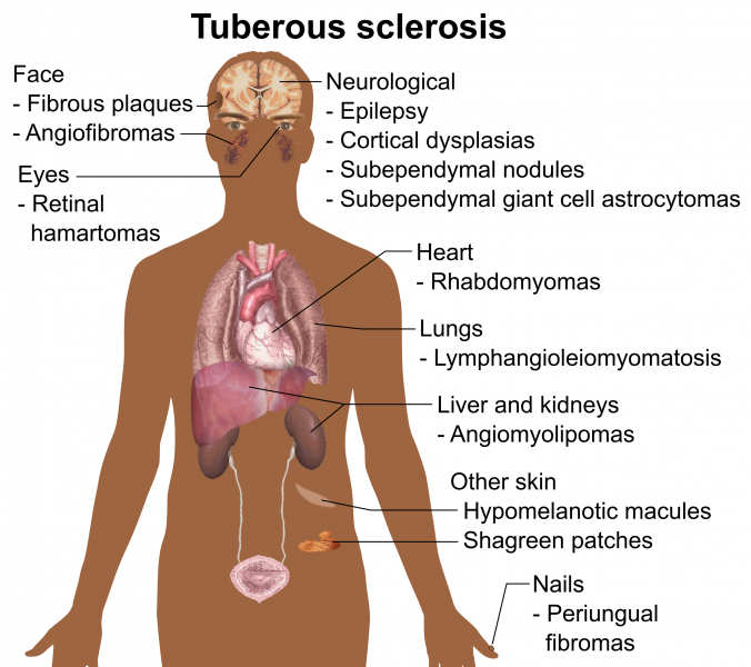 symptoms_and_signs_of_tuberous_sclerosis-4462352