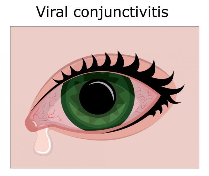 viral-conjunctivitis-1-1024x862-8900132