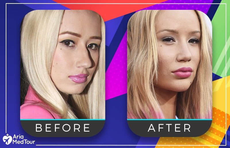 iggy-azalea-nose-job-before-after-8010766