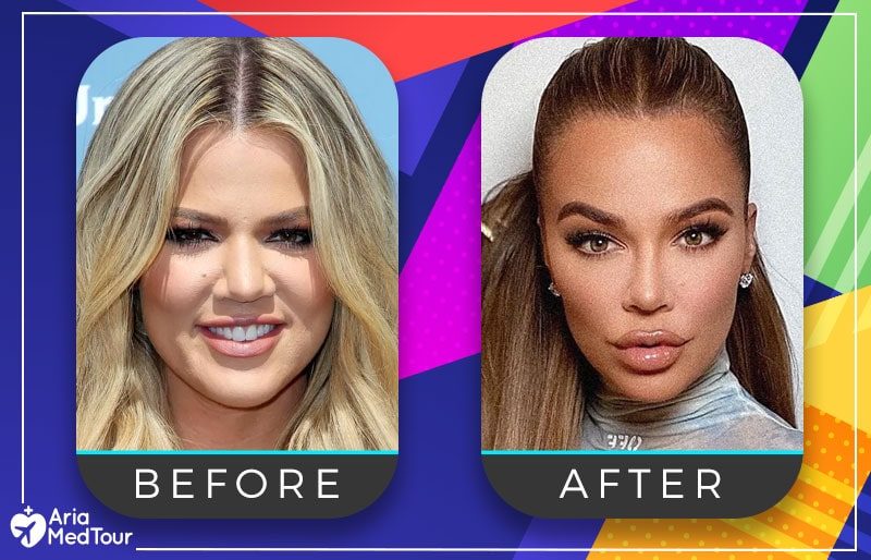 khloe-kardashian-nose-job-before-afterjob-min-4044573