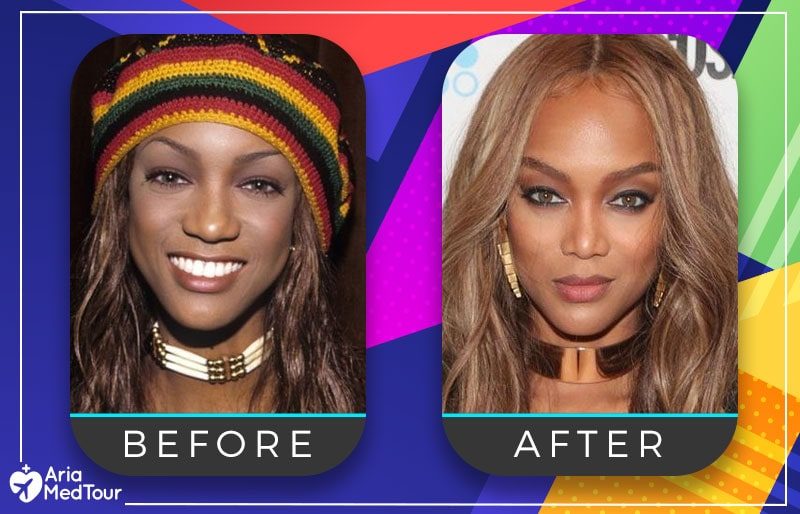 tyra-banks-nose-job-before-after-4928433