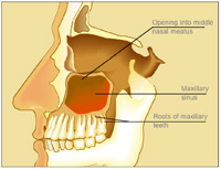 ¿Pueden los problemas dentales causar sinusitis maxilar?