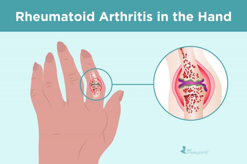 6 síntomas inesperados de artritis reumatoide que debe consultar al médico de inmediato