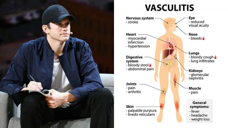 Vasculitis como Ashton Kutcher: qué es esta enfermedad y cómo detectarla a tiempo