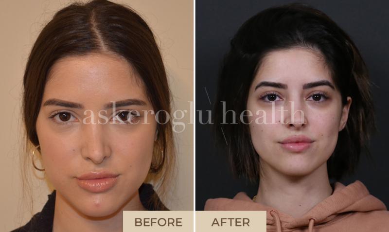 Cómo poner tu rostro en forma en una hora: tratamientos exprés incluso en Hollywood