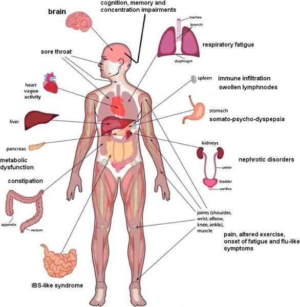 Síndrome de fatiga crónica: síntomas