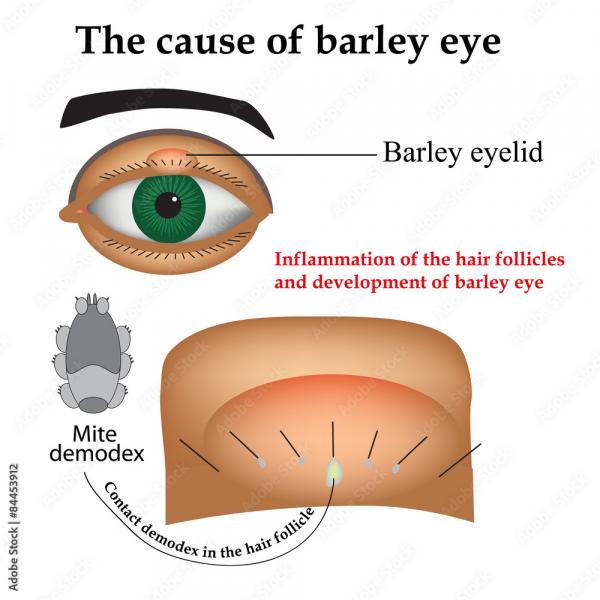 Cebada en el ojo: causas psicosomáticas (las bacterias no tienen la culpa)