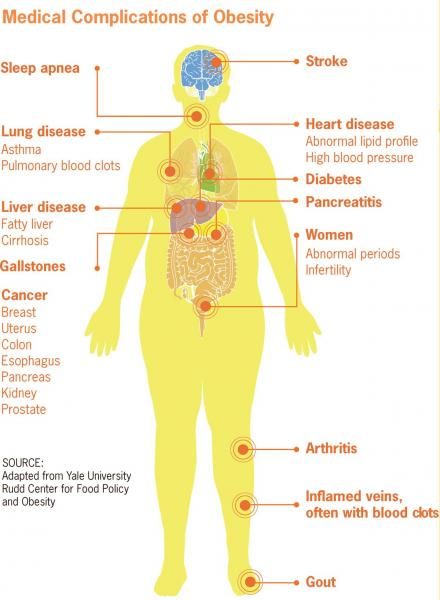 1200px-medical_complications_of_obesity-2758934-2062992