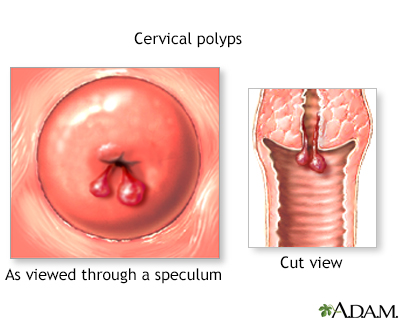 Pólipos cervicales: causas, síntomas y si deben extirparse siempre