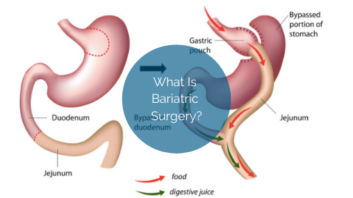 Por qué se popularizó la bariátrica