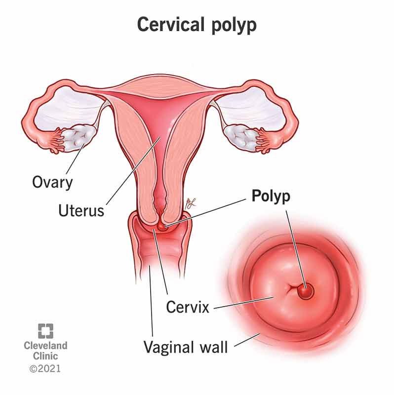 Pólipos cervicales: síntomas