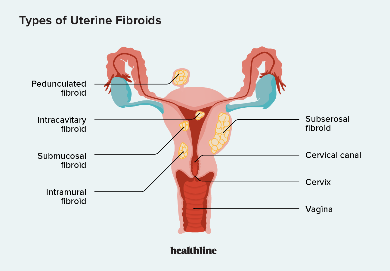 Posibles consecuencias de la embolización de la arteria uterina: