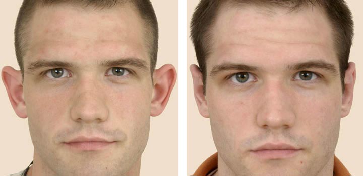 Cirugía de remodelación de orejas: ¿quién se la hace y por qué?