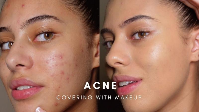Por qué no funcionan los cosméticos para el acné: 8 errores que puedes solucionar