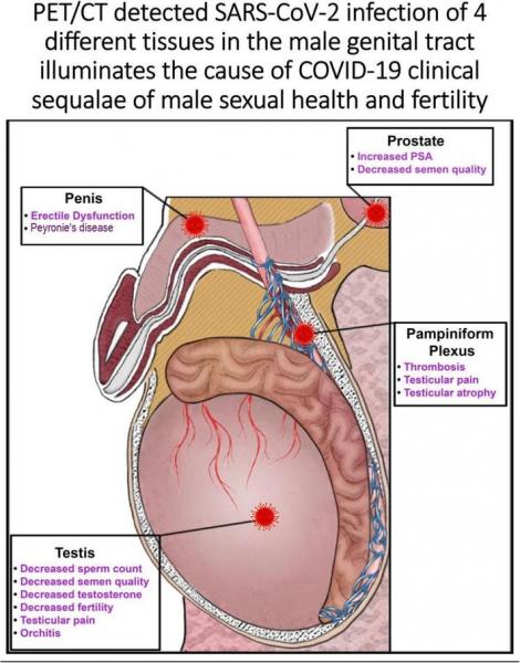 Este hallazgo ha causado alarma en la comunidad médica, ya que sugiere que el Covid-19 podría tener implicaciones a largo plazo en la salud sexual y el bienestar de los pacientes varones. El mecanismo exacto de este fenómeno aún no se conoce del todo, pero los investigadores creen que puede estar relacionado con el impacto del virus en el flujo sanguíneo y el daño a los vasos sanguíneos de la región genital.