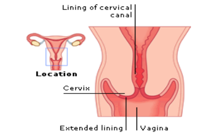 Pregunta para un ginecólogo: ¿debo cauterizar una erosión?