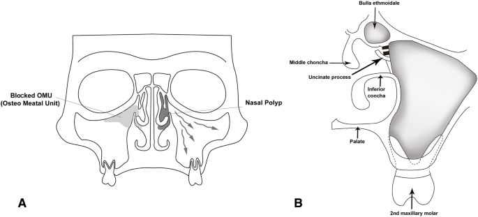 ¿Pueden las enfermedades dentales causar sinusitis maxilar?