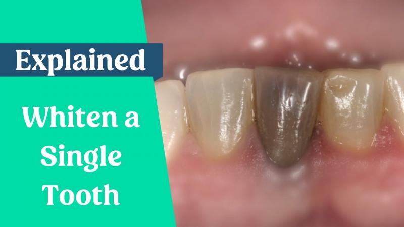 Por qué se oscurece un diente