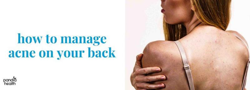 Granos en la espalda: causas y cómo eliminarlos
