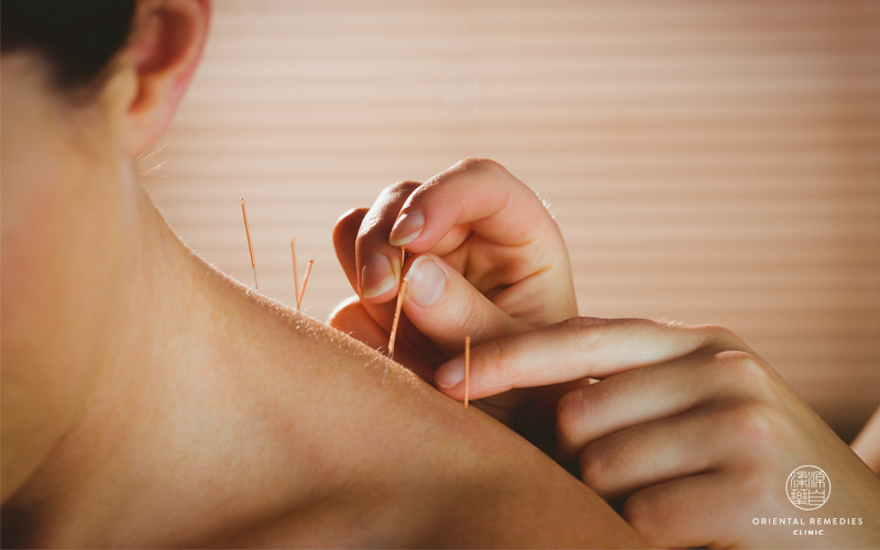 Mito 3: la acupuntura tiene muchas contraindicaciones