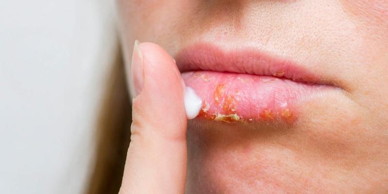 Cómo hidratar los labios secos en casa: clasificación de los mejores bálsamos, geles y barras de labios