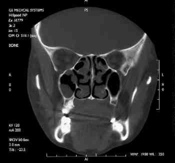 La relación entre los problemas dentales y la sinusitis maxilar