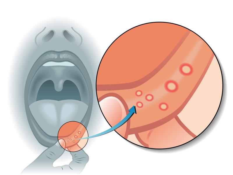 Pregunta al dentista: cómo tratar la estomatitis en adultos en la boca