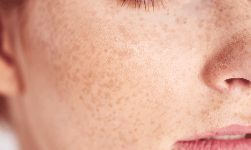 10 preguntas al dermatólogo: sobre la eliminación de lunares, los peligros de las pecas y las causas inesperadas de la piel seca