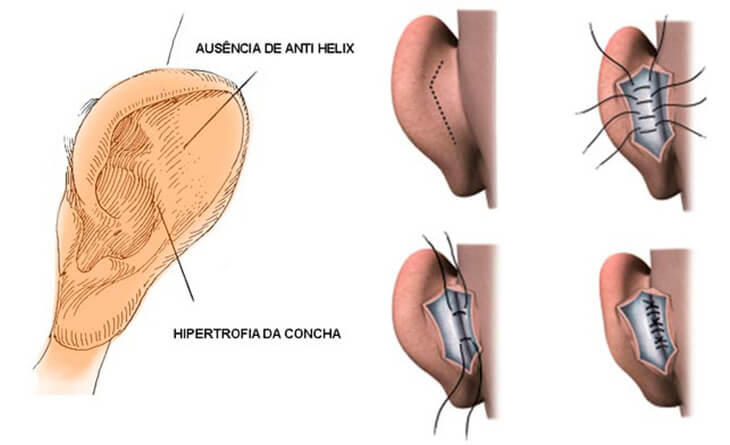 No más Cheburashka: 5 datos que debe conocer si está pensando en someterse a una otoplastia