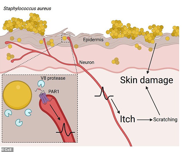 Dermatitis: si la culpa es del sistema inmunitario o de causas psicológicas