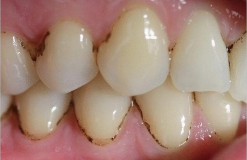 3. 4. Fluorosis