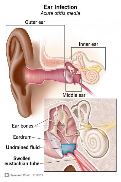 Otitis: síntomas y tratamiento en adultos