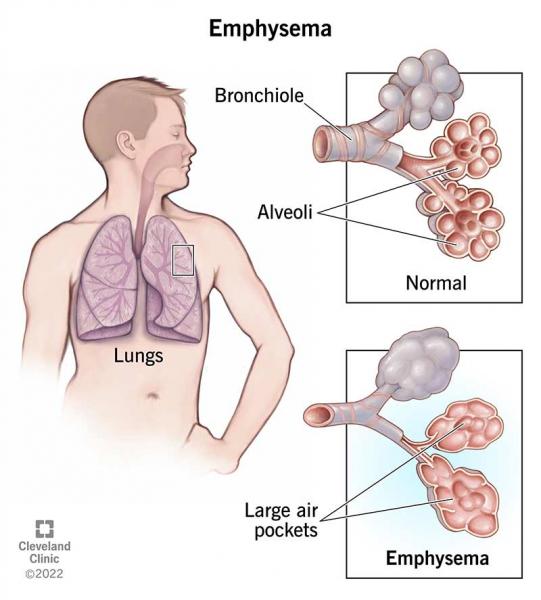 Consejos sencillos para proteger sus pulmones