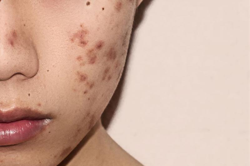 Tratamientos cosméticos para ayudar a controlar el acné (y las cicatrices posteriores)