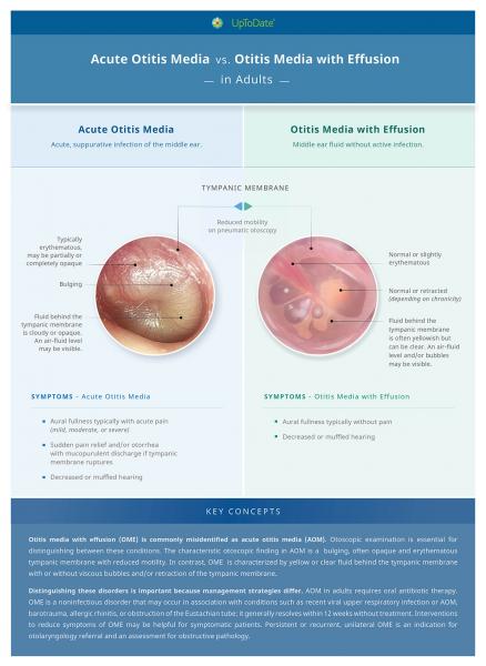 Laberintitis (otitis media interna):