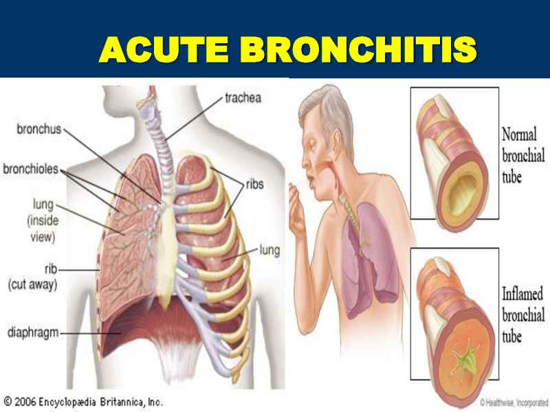 Qué es la bronquitis crónica: síntomas y tratamiento en adultos