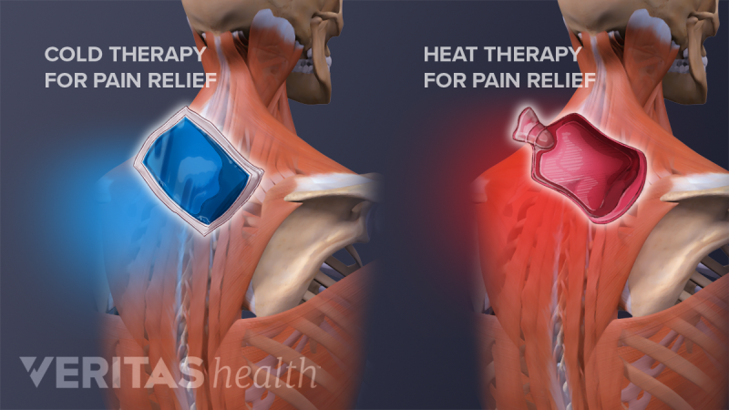 3. Neuralgia intercostal idiopática