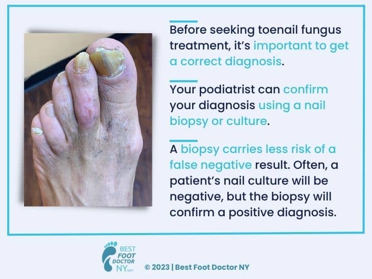 Cómo curar los hongos en las uñas de los pies: principales reglas y errores que no se deben permitir