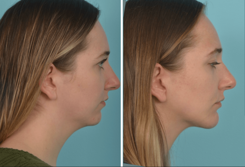 Si sueña con un cuello como el de Jolie, esta innovadora microcirugía puede ser la respuesta que estaba buscando. Abrace su belleza interior y haga retroceder el reloj con