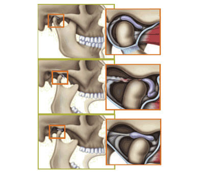 Chasquido dental: ¿por qué cruje la mandíbula y hay que hacer algo al respecto?