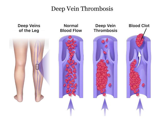Todo sobre la trombosis venosa de las piernas y la embolia pulmonar: por qué aparece y cómo afecta el coronavirus a su desarrollo