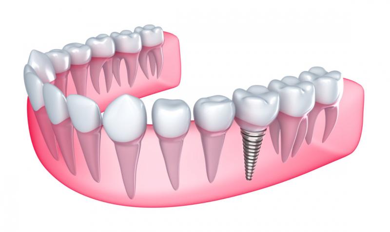 Cuándo son mejores los implantes