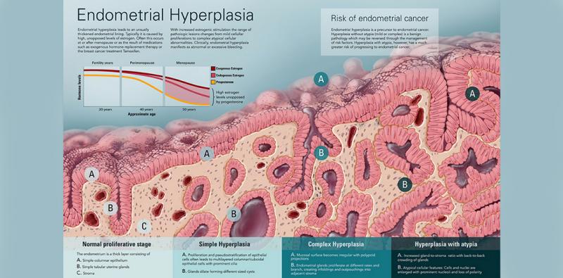 Hiperplasia endometrial: síntomas alarmantes y tratamiento