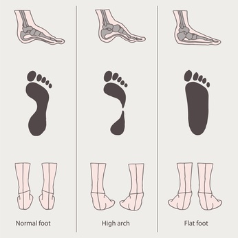 Plano no significa bueno: cómo identificar los pies planos