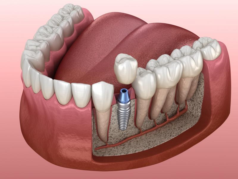 Por qué los dientes naturales son mejores que los implantes