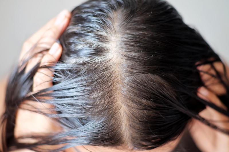 Cómo detener la caída del cabello después de la covida