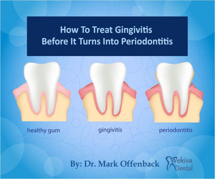 Gingivitis: Tratamiento en adultos