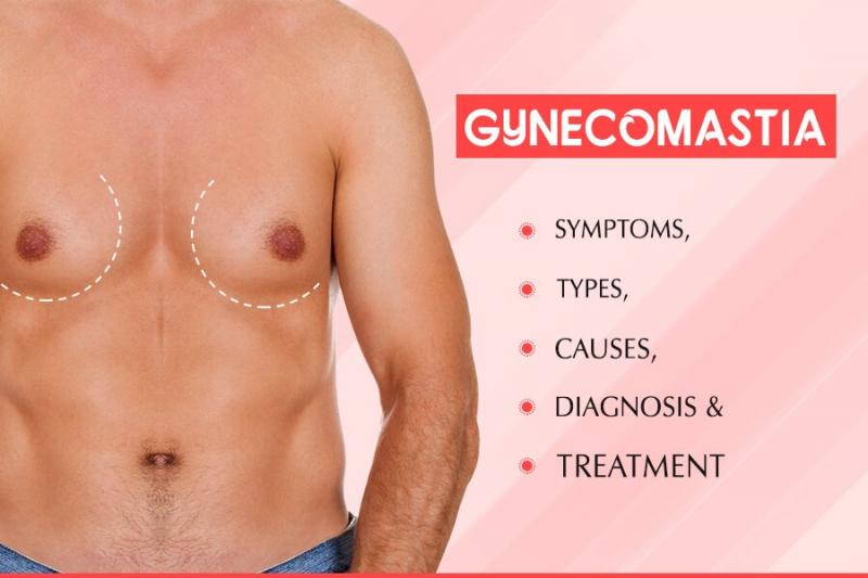 Por qué crecen los pechos de un hombre: qué es la ginecomastia y en qué casos está indicada